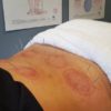 Sports Recovery Acupuncture: 6 Key Benefits Uncovered