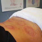 Sports Recovery Acupuncture: 6 Key Benefits Uncovered